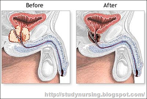 Cialis And Prostate Surgery